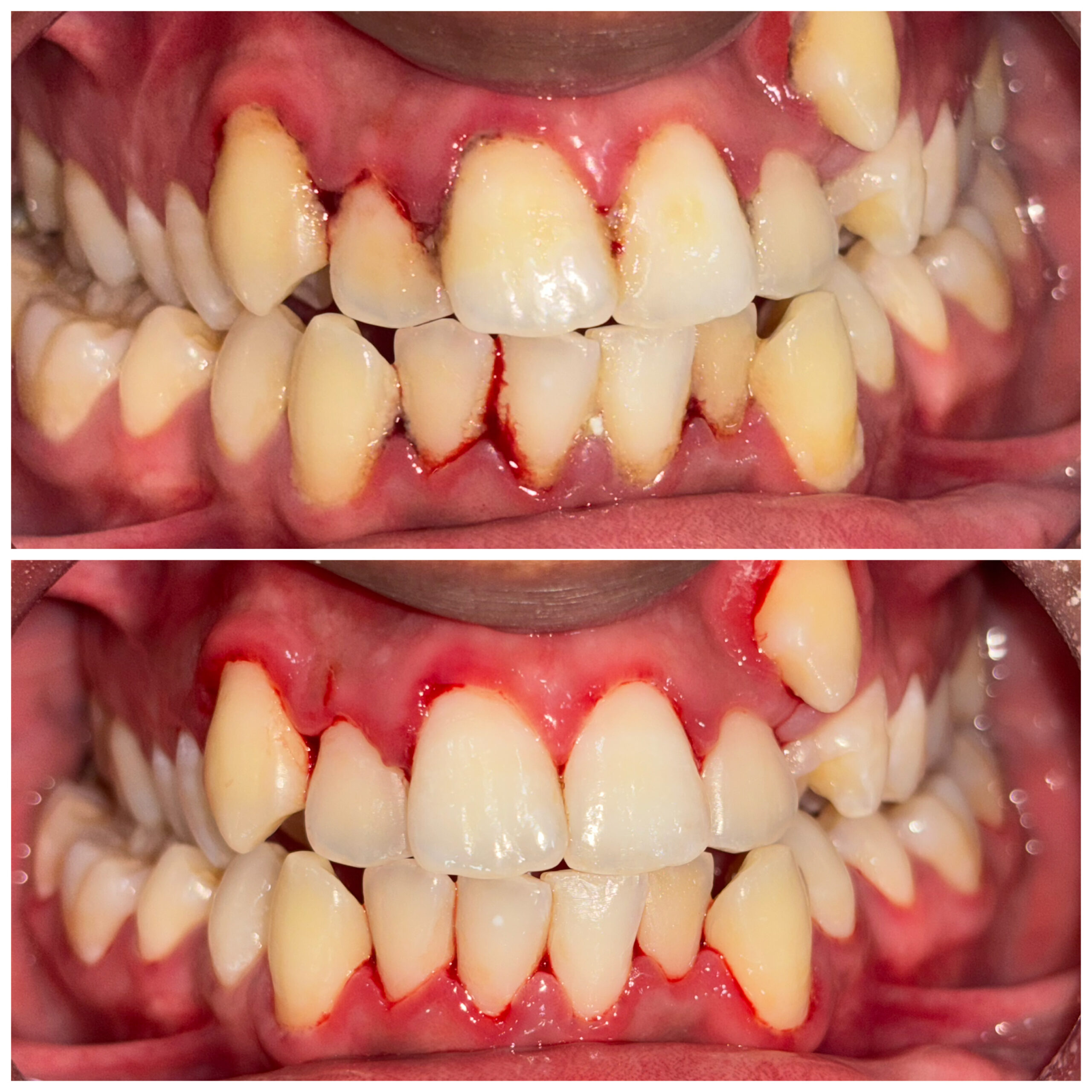 Teeth Whitening: Is It Safe for Your Enamel?